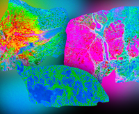 neofleX 116-pleX MALDI-HiPLEX IHC images on lung cancer samples: control, adenocarcinoma, squamous cell. Data courtesy Prof. Bernd Bodenmiller, U. of Zürich and ETH, Switzerland (Graphic: Business Wire)